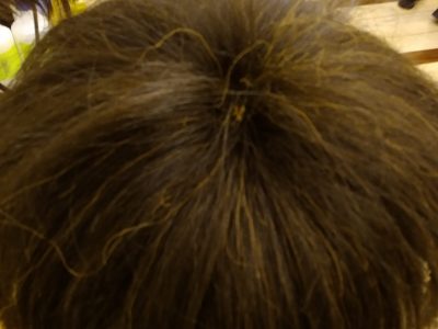 固定式のセルフケア